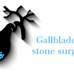 Gallbladder Stone Surgery