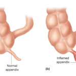Laparoscopic Appendix Surgery Varanasi