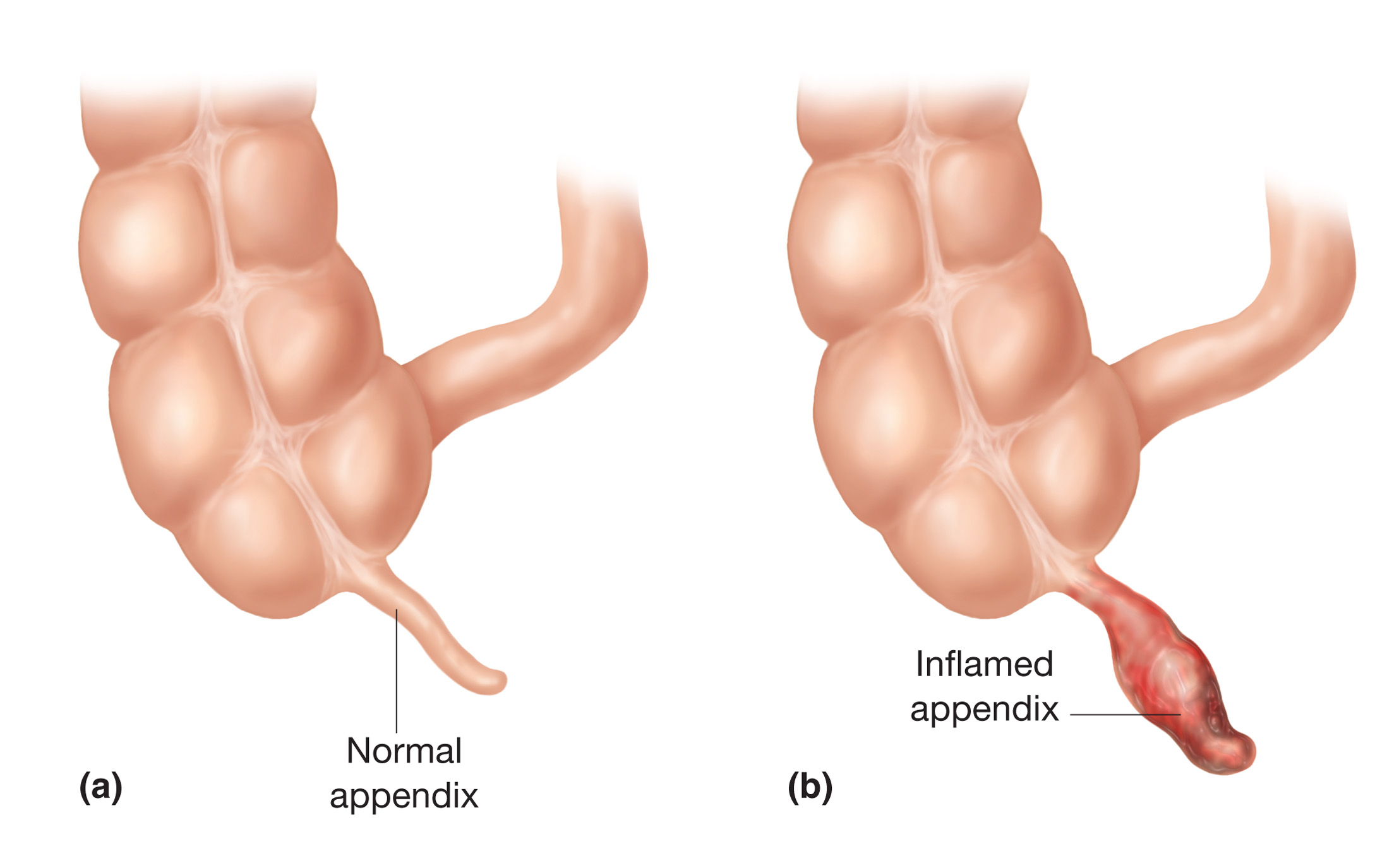 Laparoscopic Appendix Surgery Varanasi
