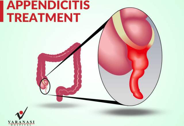 appendicitis treatment Varanasi