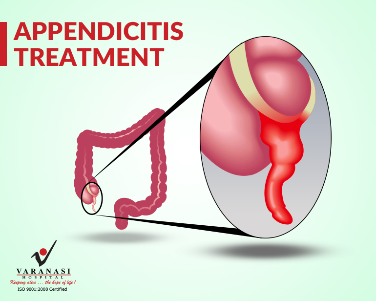 Appendicitis Surgery in Varanasi - Laparoscopic Appendicitis Treatment
