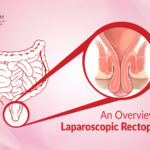 Laparoscopic Rectopexy