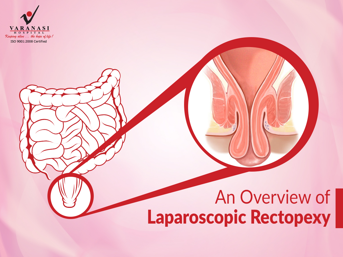 Laparoscopic Rectopexy