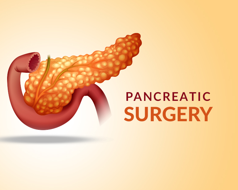 Pancreatic Surgery in Varanasi