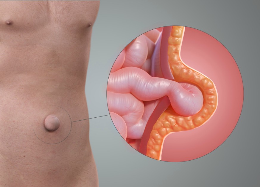 Umbilical Hernia: Its Complications and Treatment