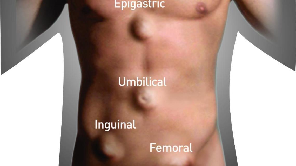 Epigastric Hernia and Other