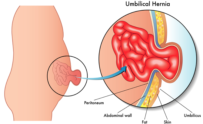 Image result for umbilical hernia