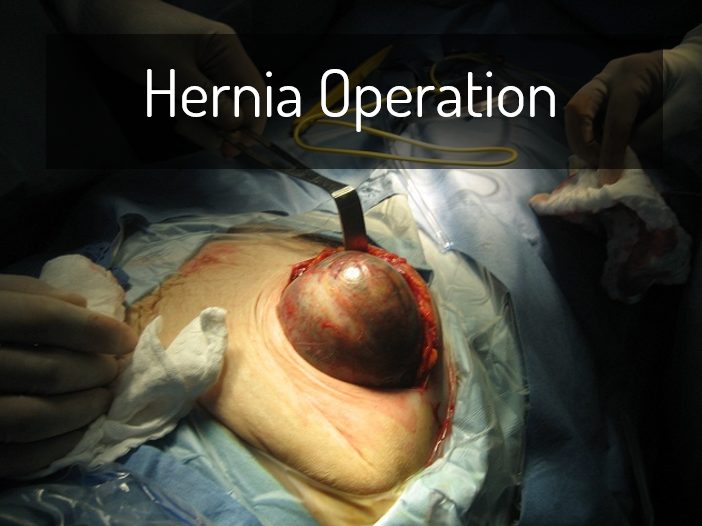 hernia surgery in Varanasi