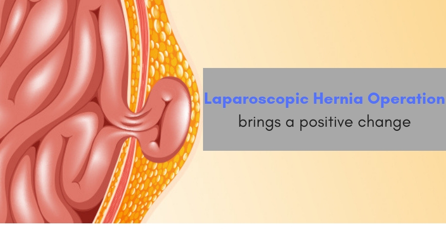 Laparoscopic-Hernia-Operation